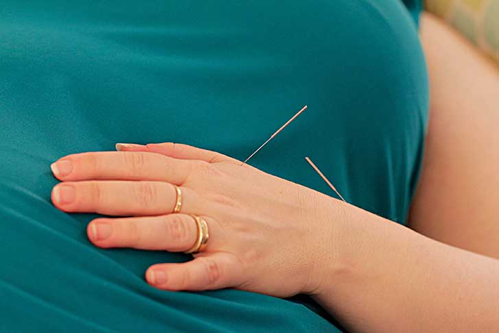 acupuncture needles in hand and wrist