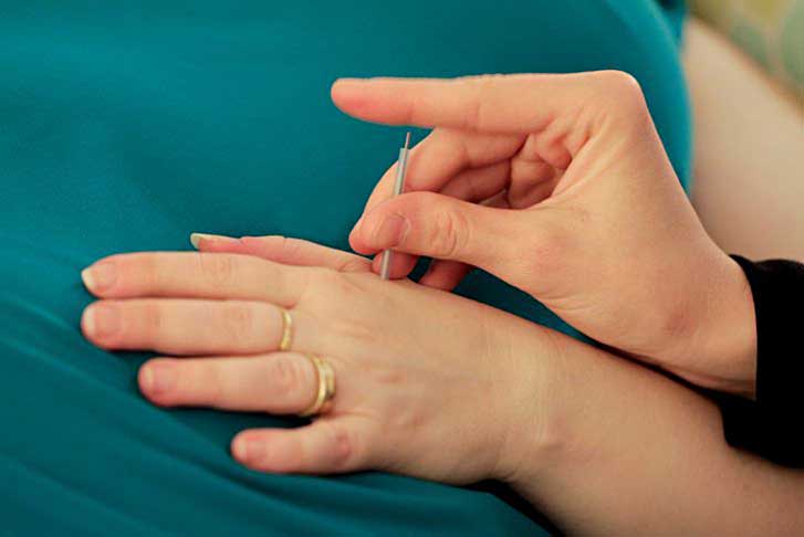 acupuncture needle being inserted in hand
